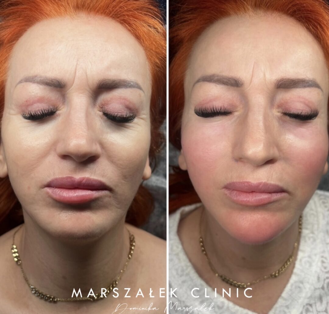 Wolumetria twarzy autorską metodą ,,Marszałek Face Lift”