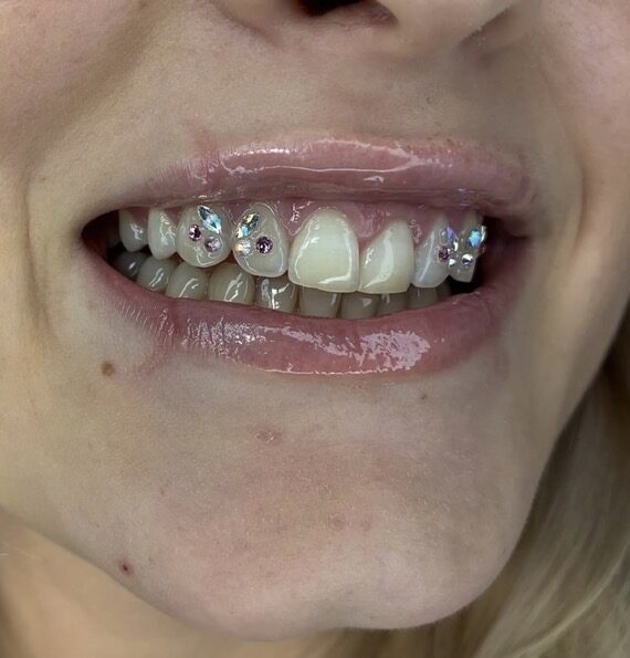 Tooth gems diamondsmile zakładanie i zdejmowanie biżuterii nazębnej