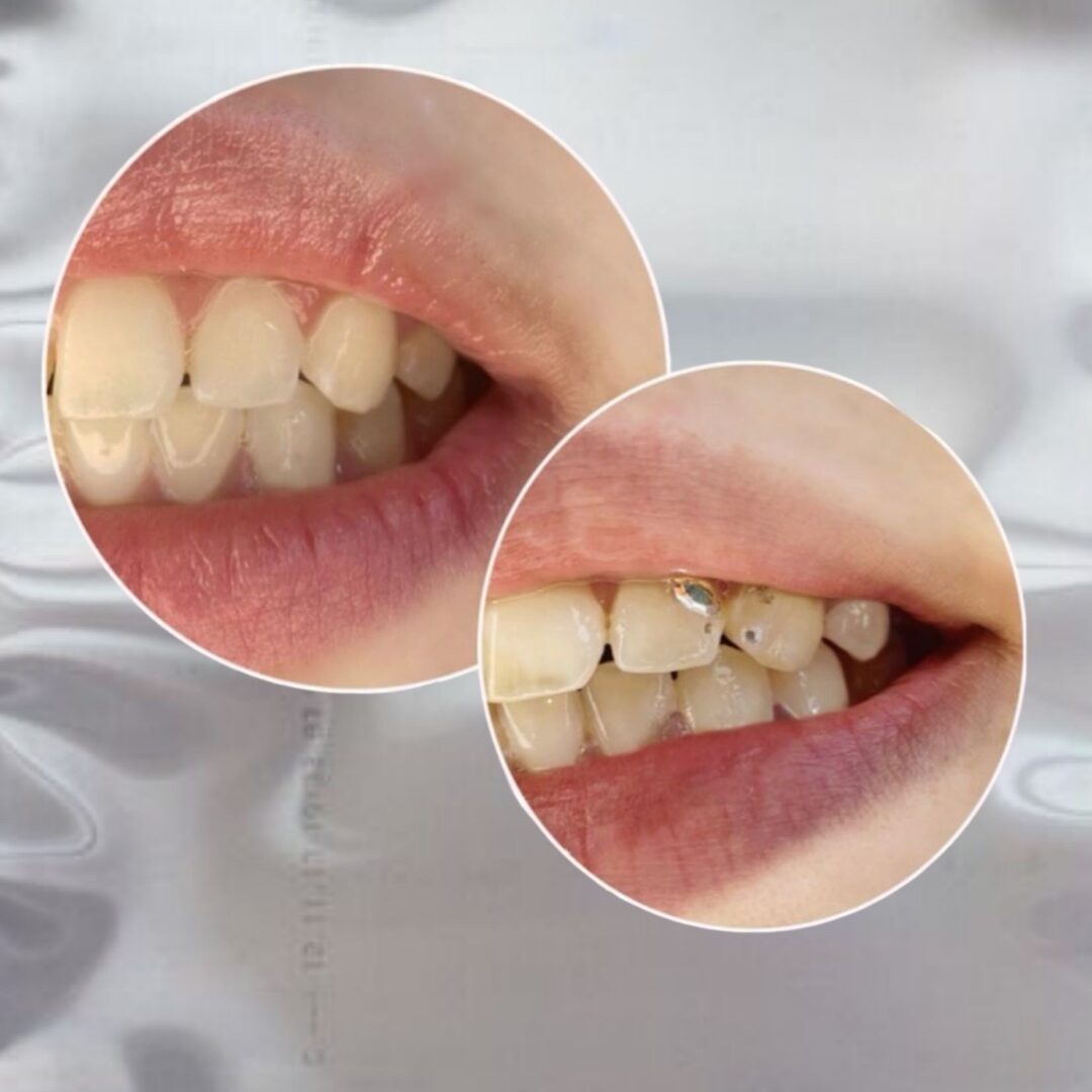 Zdejmowanie Biżuterii Nazębnej TOOTH GEMS