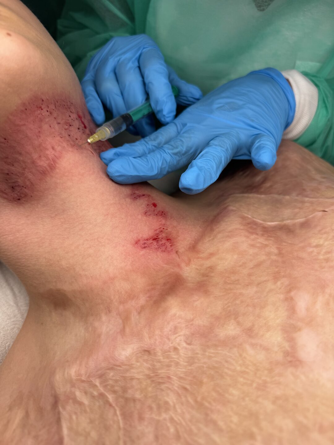 Time for Scar Warsztat Kompleksowych Technik Pracy z Blizną